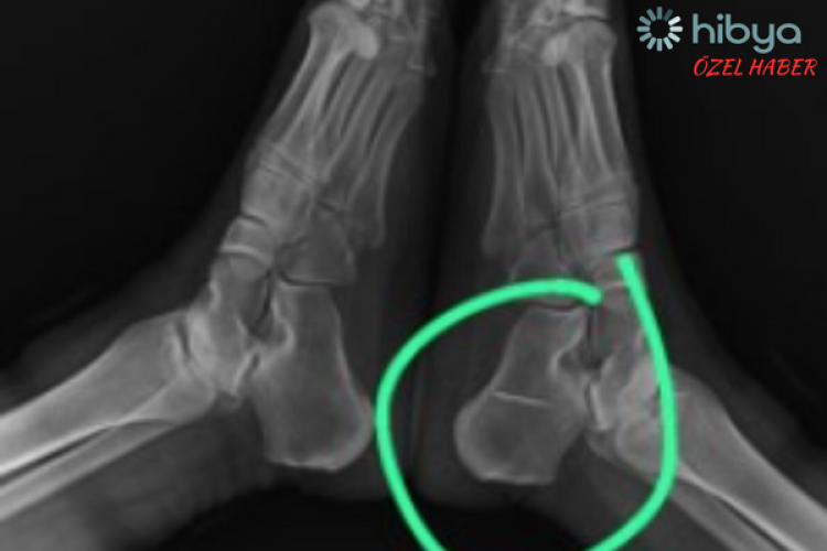 Mide rahatsızlığı, küçükken ayağına saplanan iğnenin ortaya çıkmasını sağladı