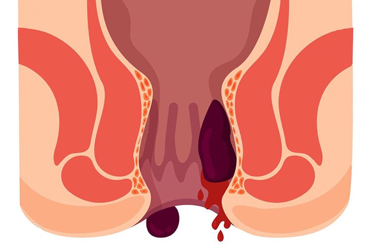 Hemoroid ve anal fissürün ciddiye alınması uyarısı