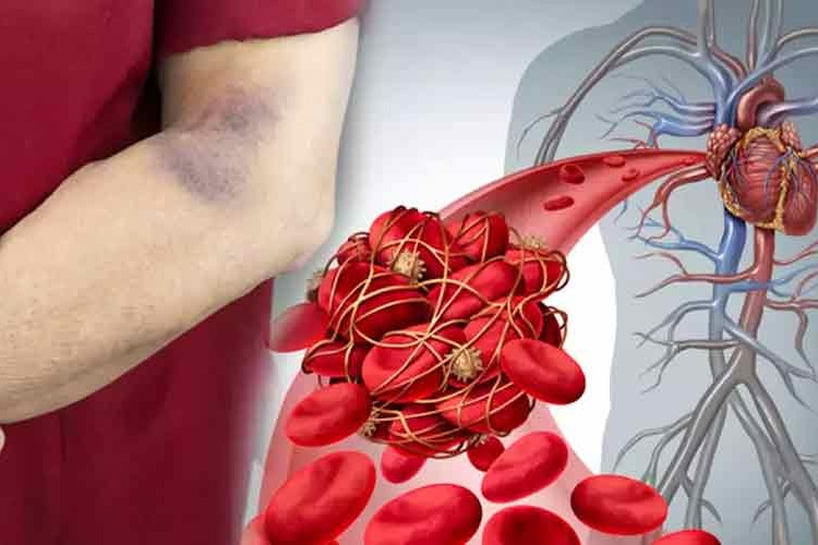 "Artan pıhtılaşma ve inme vakaları için genetik test" uyarısı