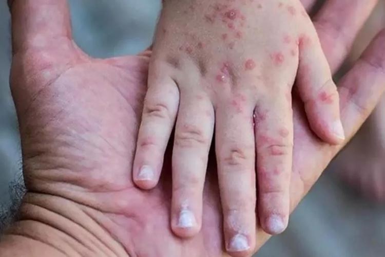 Maymun çiçeğiyle ilgili acil durum ilan edildi