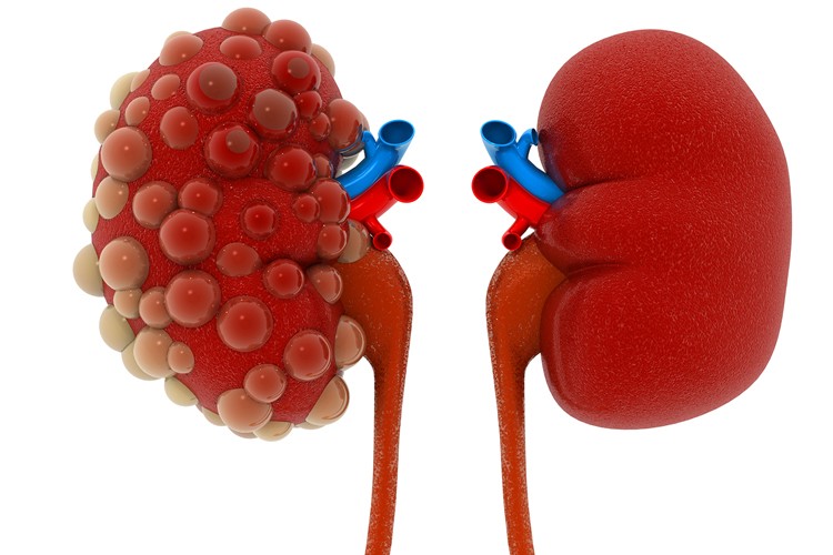 Polikistik böbrek hastalığı yavaş gelişir, her şey hızla değişir