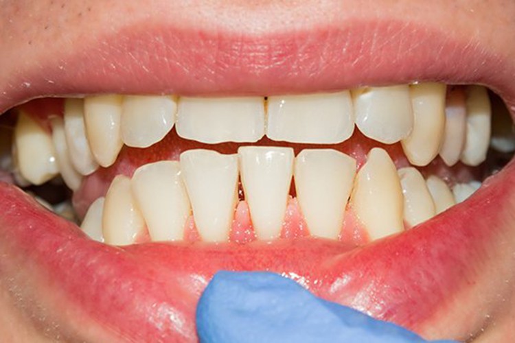 Diş eti çekilmesinin en büyük sebebi diş taşı