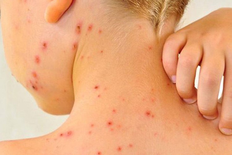 Kızamık virüsünün vücuttan atılabilmesi mümkün