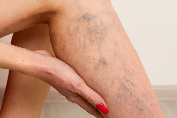 Güncel tedavi yöntemleriyle varisten kurtulmak mümkün