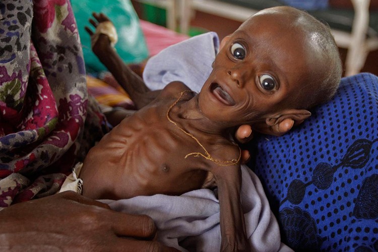 Yüzde 10.8 yetersiz besleniyor