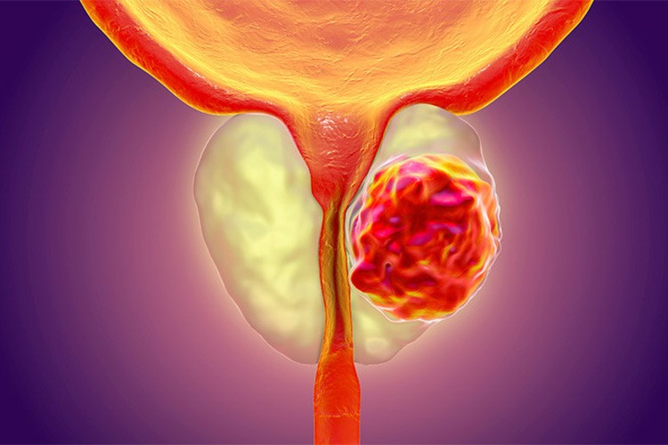 Prostat hastalığının tedavisine ilişkin değerlendirme