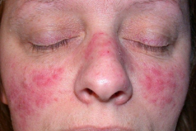 Gül hastalığı kadınlar ve açık tenlilerde daha çok görülüyor