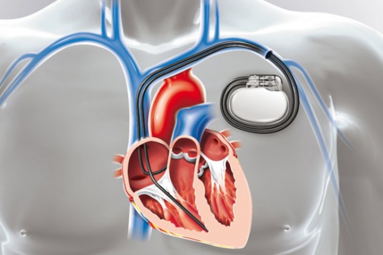 Kardiyak lead'lerin etkin şekilde çıkarılması için inovatif çözüm