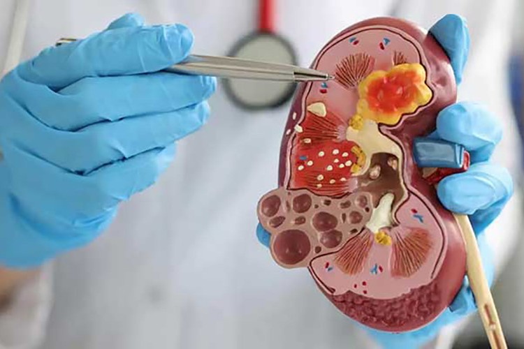 Küresel ısınma böbrek taşı riskini artırıyor