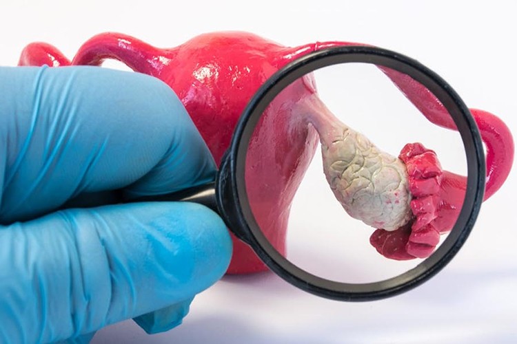 Çikolata kistleri kadınlarda yumurta kalitesi ve sayısını azaltabiliyor