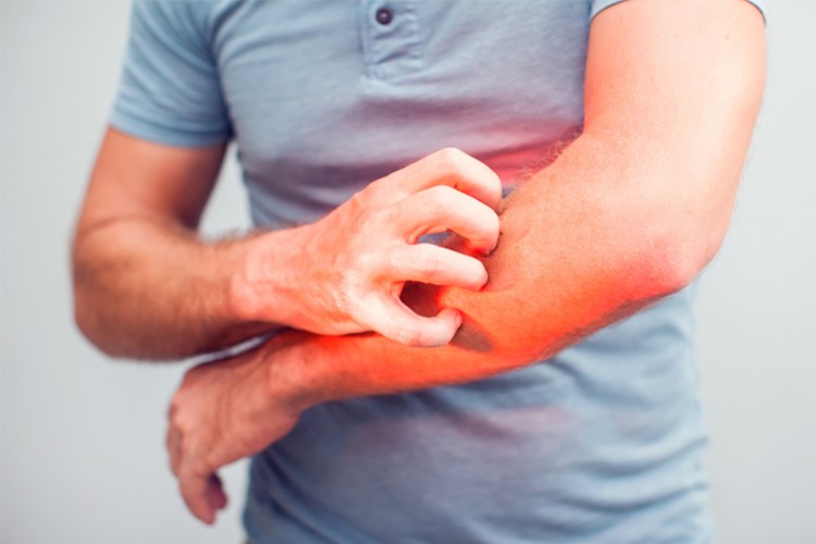 Uyuz İlacının Karşılanması İçin Kampanya Başlatıldı