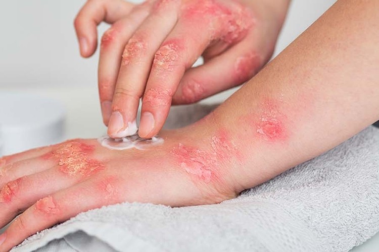 Giderek Artan Uyuz Tehlikesine Karşı Önleminizi Alın