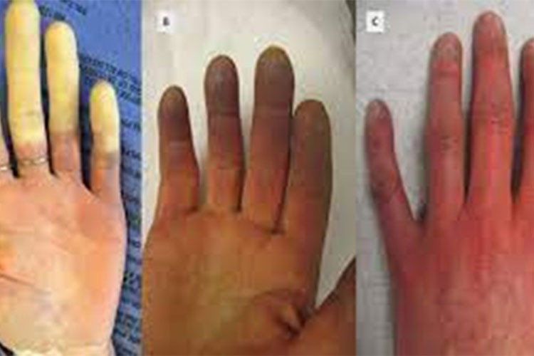 "Raynaud fenomenide erken tanı önemli"