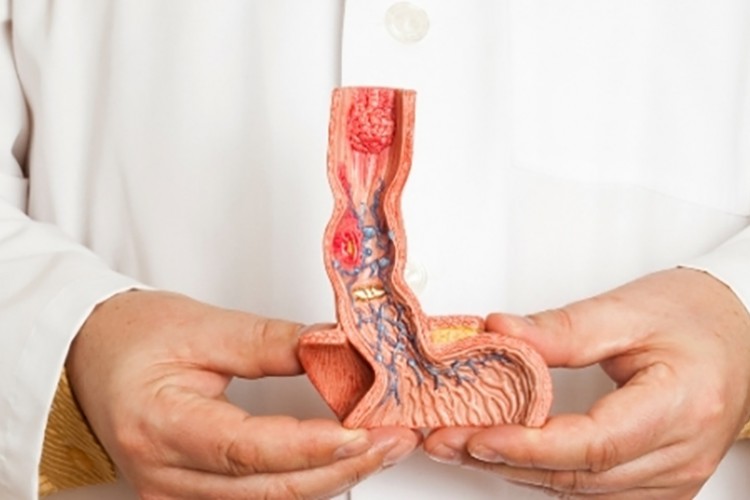 Yemek borusu kanserinde cerrahi tedavi uygulanabilir