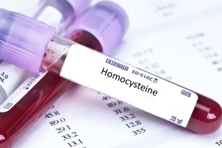 Kalp Hastalıkları Riski için Homosistein Testi Yaptırın...