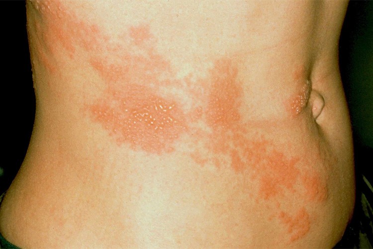 Zonadan korunmak için en etkili yöntem aşı