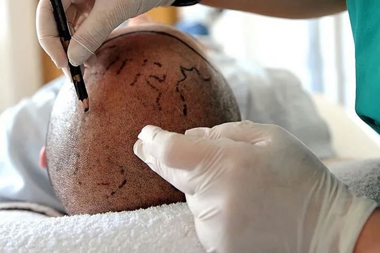 Saç ekimi merkezlerine yeni standart getirildi