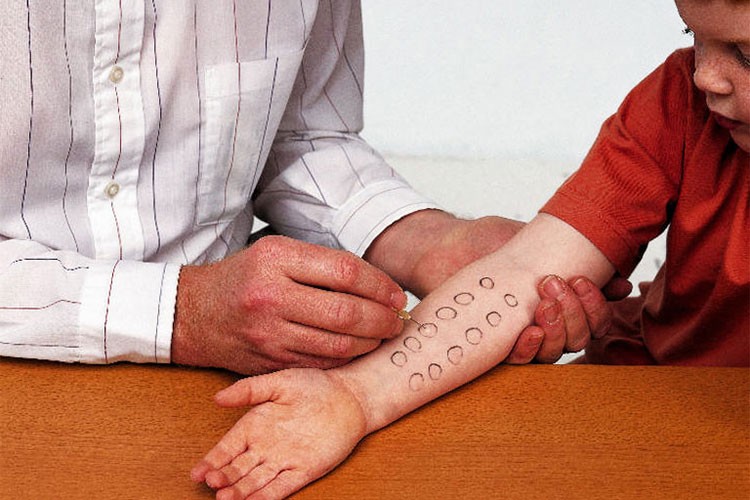 Alerji gelişimini engellemek için beslenme önemli