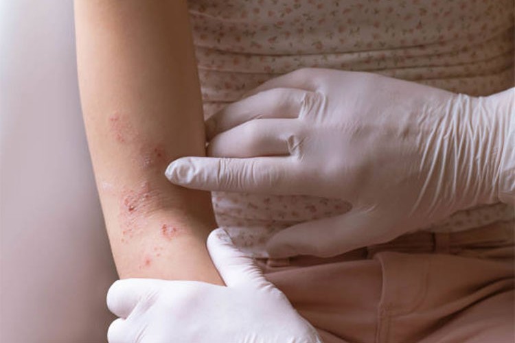 Egzama çocuklarda daha sık görülüyor