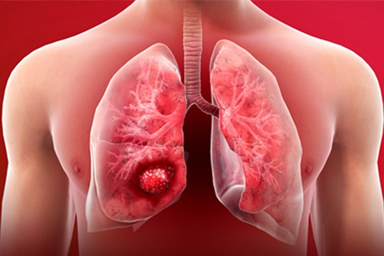 Her 5 kanser ölümünden birine akciğer kanseri neden oluyor