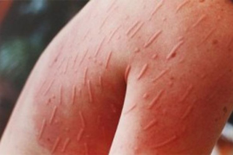 "Uyuz vakaları her geçen gün artıyor" uyarısı