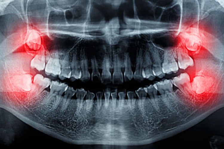 Yirmilik dişler ihmale gelmiyor