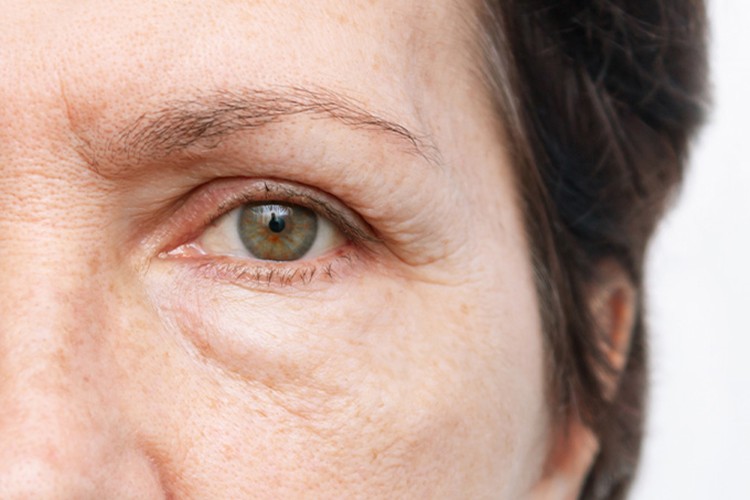 Göz Altı Şişliği Her Zaman Yorgunluk Belirtisi Olmayabilir