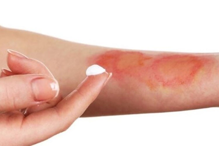 "Yanığın üzerine yağ, diş macunu, zeytin sürmeyin" uyarısı