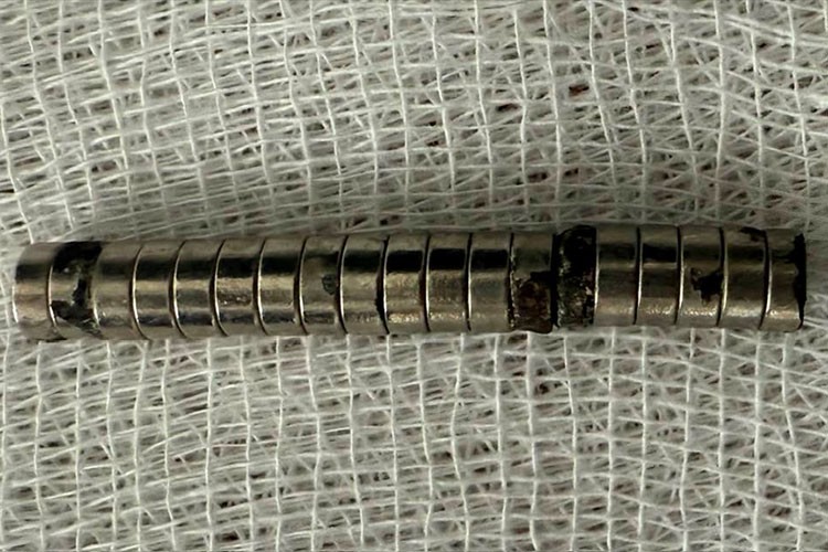 3 yaşındaki çocuğun yemek borusundan 19 mıknatıs çıkarıldı