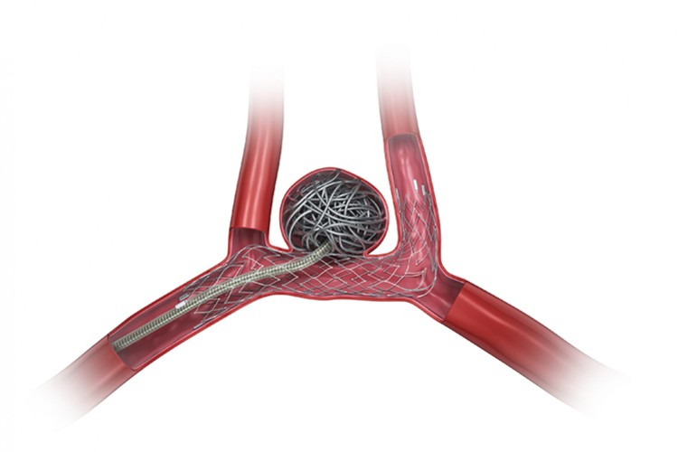 Türkiye'nin yapay damar teknolojisine AB onayı