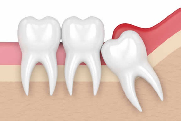 Gömülü dişler tedavi edilmezse ciddi sağlık sorunlarına yol açabilir