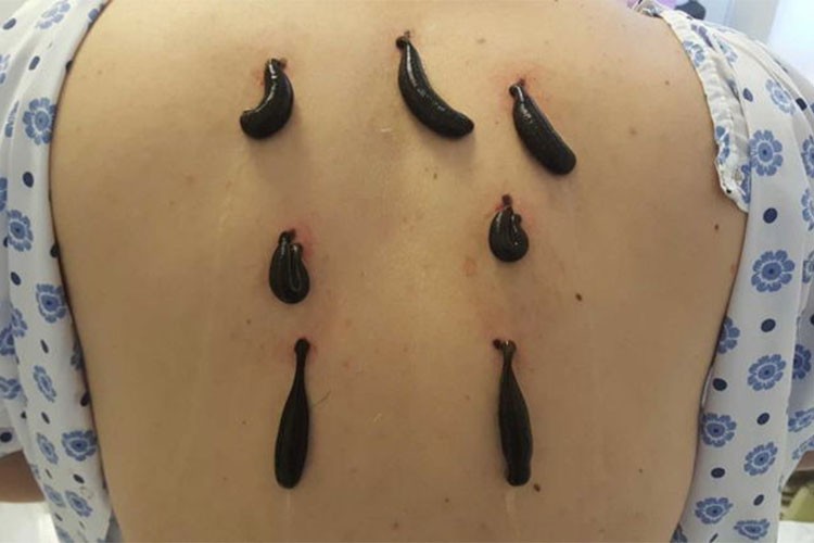 Tıbbi sülük kullanım esaslarında düzenlemeye gidildi