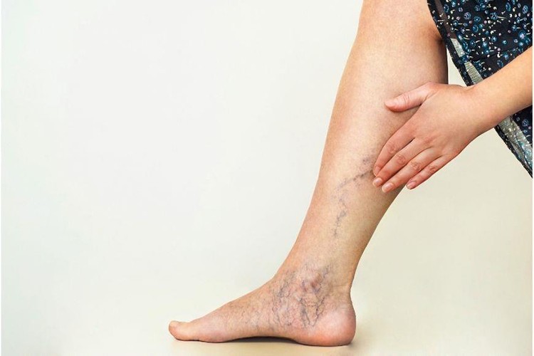 Varis tedavisinde yüzde 98 başarı sağlıyor