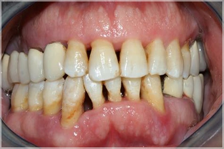 Diş eti çekilmesi sorunu diş kaybı ile sonuçlanabilir!