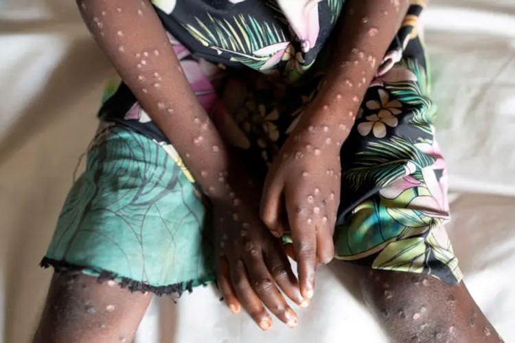 Maymun çiçeği nedir ve nasıl yayılır?