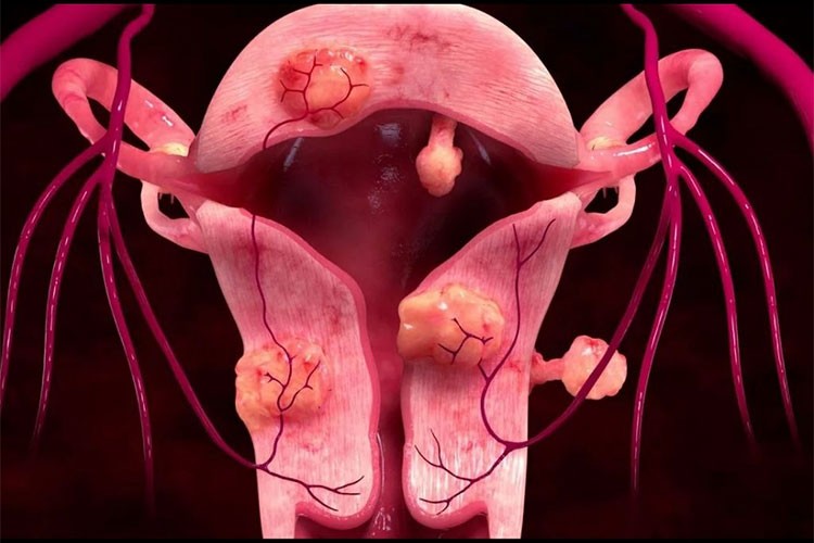 Miyomun belirtileri ve tedavi yöntemleri